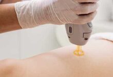 Lazer Epilasyonda Kıl Köklerinin Durumu Nedir